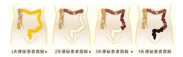 这些宿便堆积在肠道内发酵,腐败,并不断产生各种毒素,毒气,被肠粘膜