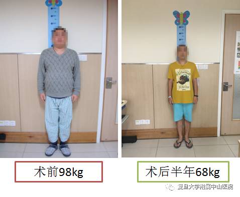 减肥手术有哪些方法_手术减肥_减肥手术多少钱