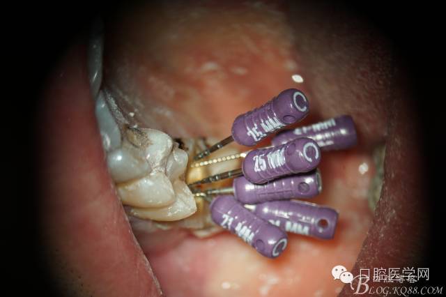 s3我的根管治疗之路上颌第一磨牙5根管治疗