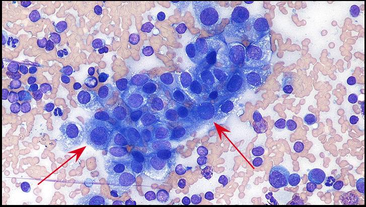 淋巴结细胞学镜检步骤及临床图片大全