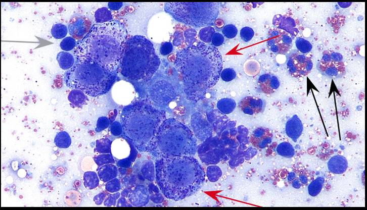 图10,淋巴结抽吸获得的转移性肥大细胞瘤.