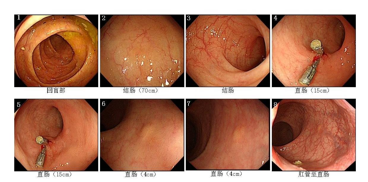 距肛门约4cm直肠可见一大小约0,4x0,4cm结节样隆起病变,宽基无活动性