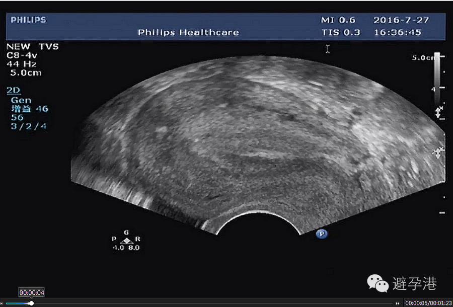 吉妮致美环怎么样吉妮致美节育器超声图像解读_https://www.jmylbn.com_新闻资讯_第4张