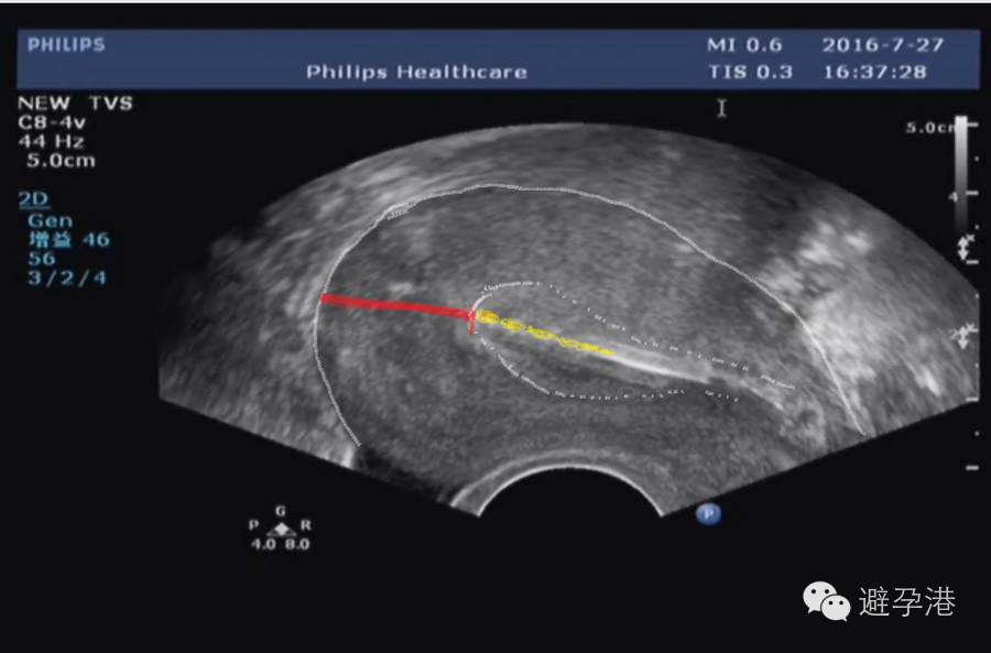 吉妮致美环怎么样吉妮致美节育器超声图像解读_https://www.jmylbn.com_新闻资讯_第9张