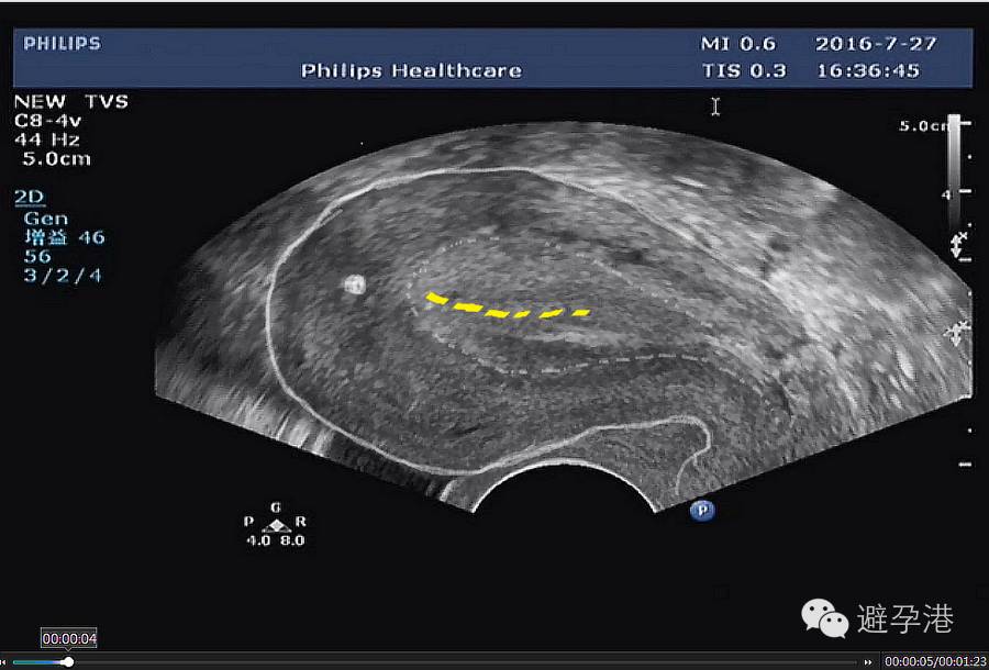 吉妮致美环怎么样吉妮致美节育器超声图像解读_https://www.jmylbn.com_新闻资讯_第5张