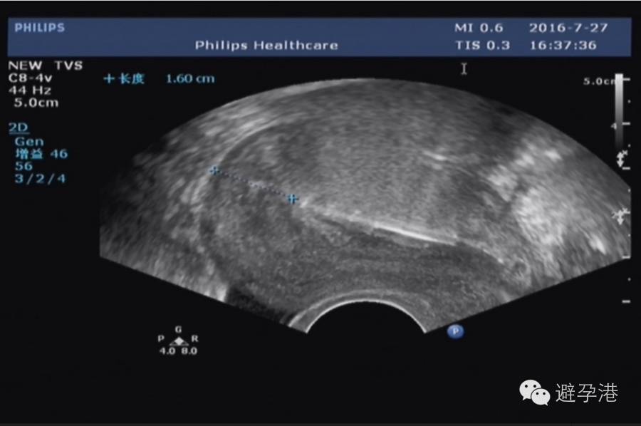 吉妮致美环怎么样吉妮致美节育器超声图像解读_https://www.jmylbn.com_新闻资讯_第8张