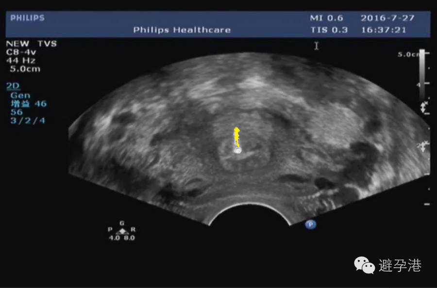 吉妮致美环怎么样吉妮致美节育器超声图像解读_https://www.jmylbn.com_新闻资讯_第7张