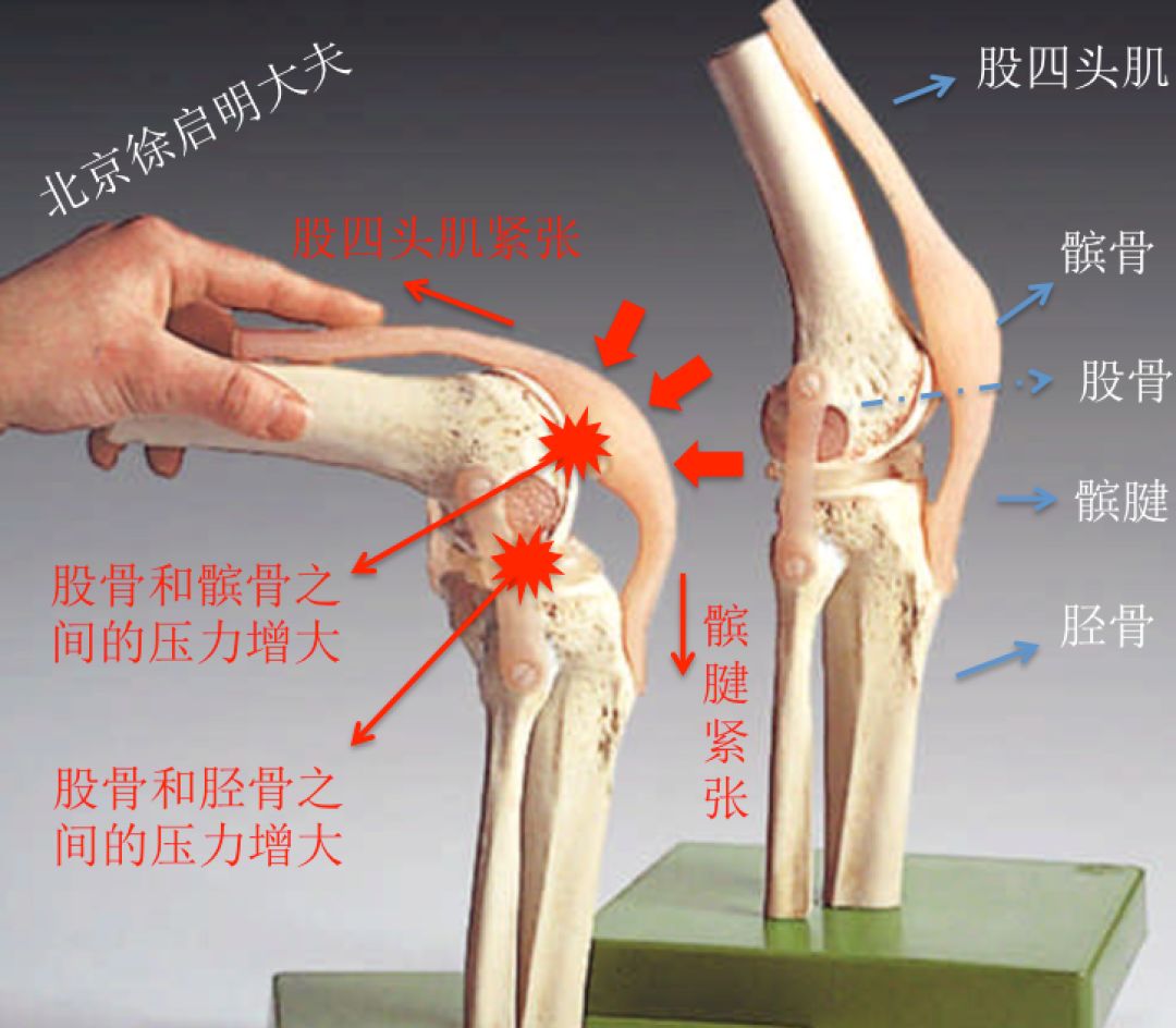 这张图一目了然的告诉我们,当膝关节处于屈曲状态的时候,髌骨和股骨