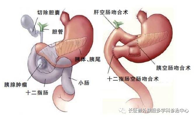 为了保证彻底地切除病灶,需切除整个胰体尾部和与之相连的脾脏,即"胰