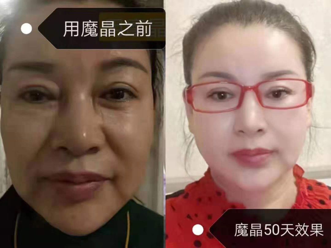 魔晶微整面膜是什么大家千万别做魔晶微整面膜了