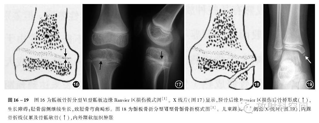 Ⅳ型:骨折线白干骺端穿过骺板软骨进入骨骺,即骨骺干骺端骨折,累及