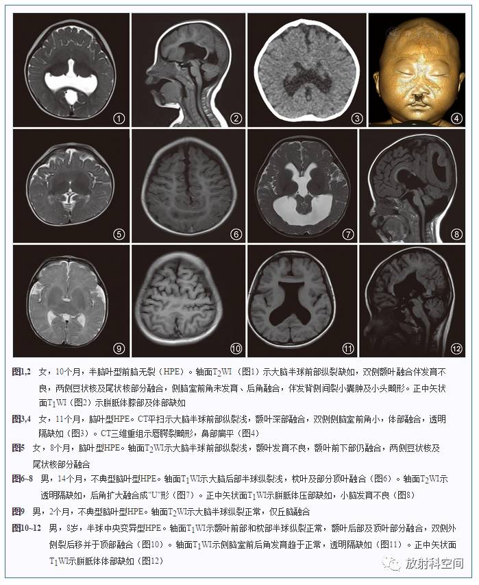 儿童前脑无裂畸形的影像表现分析