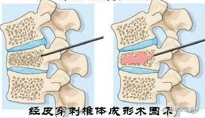 无骨水泥注入的椎体成形术仍可止痛?