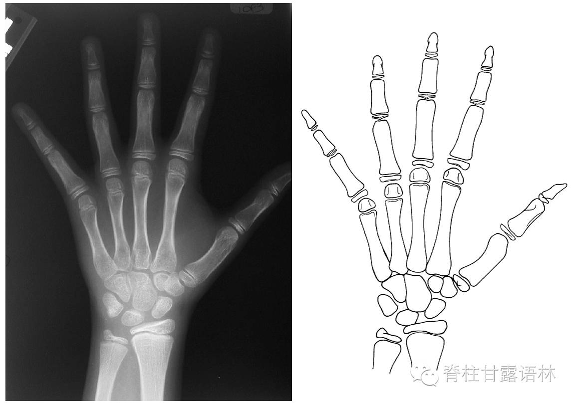 级,所有指骨骨骺未全覆盖