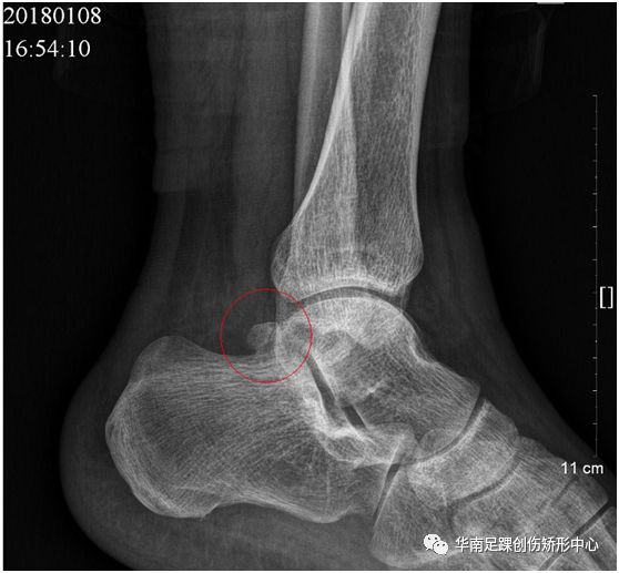 曾参军大夫患友会 距骨骨软骨损伤 小组 踝关节撞击综合征关节镜