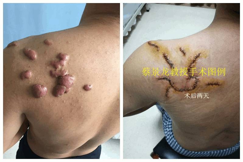 层放射治疗病例分享:肩部多发疤痕疙瘩疤痕术后初期伤口愈合不理想是