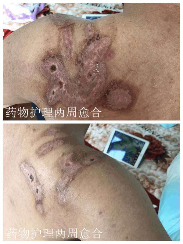 看见伤口已经愈合干燥结痂