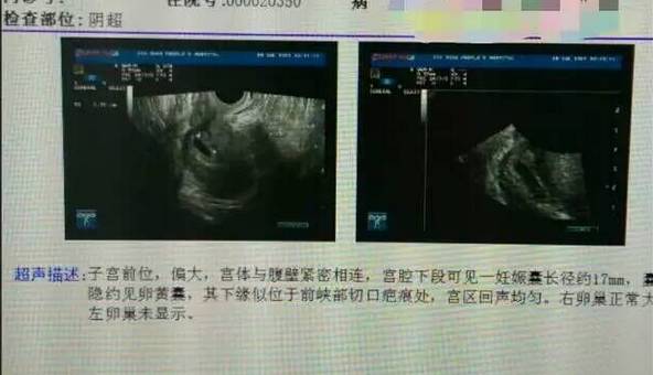 子宫刀口处怀孕 险! 奥洛克保宫祛囊 妙!-怀孕期