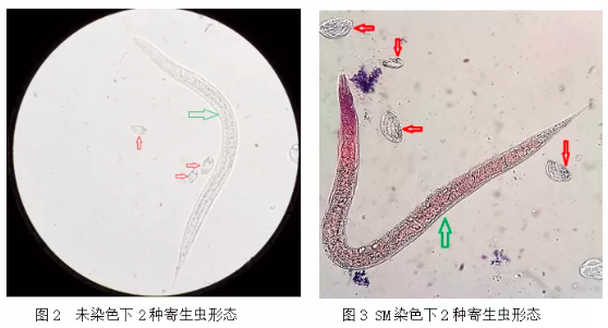 万万没想到患者尿检中发现2种寄生虫竟是因为干了这件事