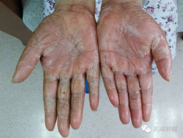 一例化疗引起手足综合征成功诊治经验分享
