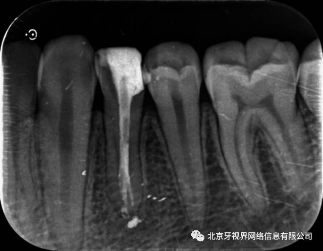 根管大赛参赛病例——左下第一前磨牙根尖分叉一例 作者:屈博