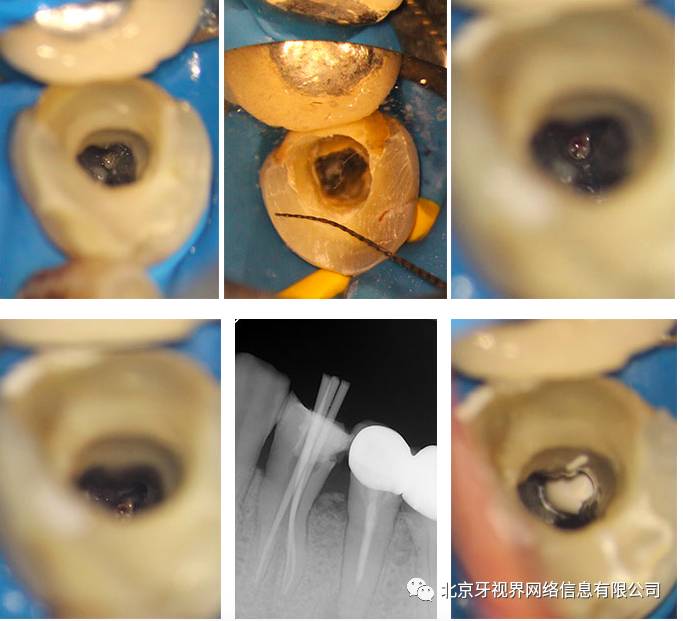 预弯hyflex cm锉,直视下插入根管口,预备至25# .