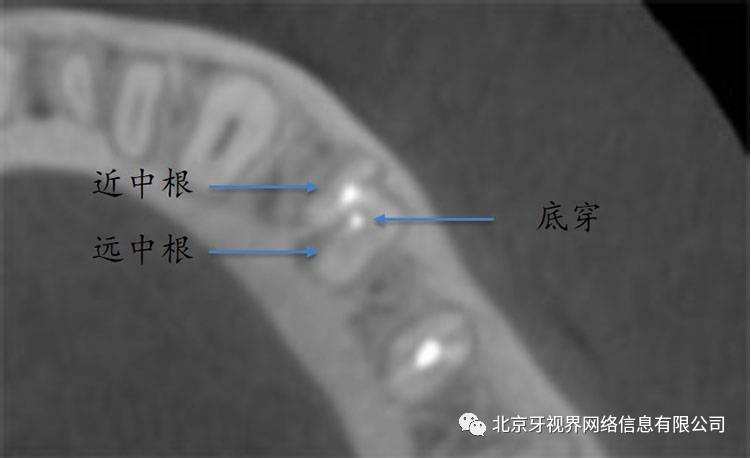 「根管视界」左下第一前磨牙三根管(底穿修补)一例9