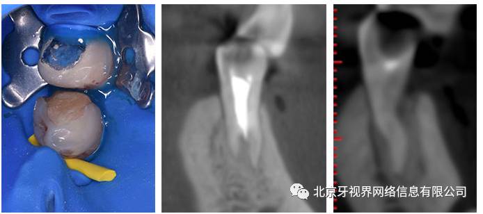 口内图 远中根冠状面截面 近中根冠状面截面