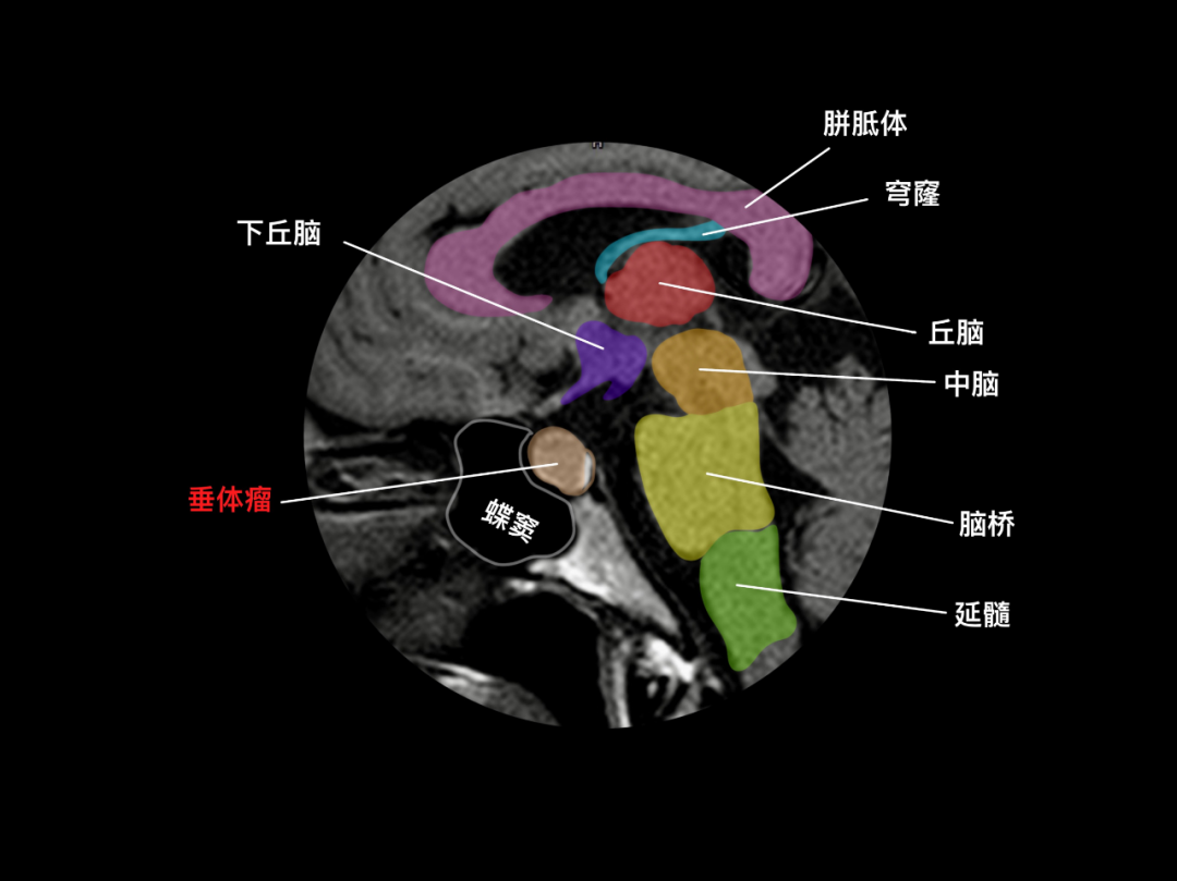 垂体瘤颅脑 mri颅脑 mrv鞍上池,脚间池,环池,四叠体池感谢徐桂兴博士