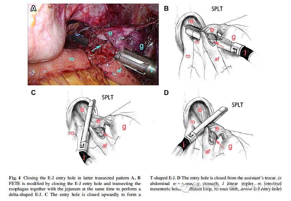 全腹腔镜全胃切除术后吻合新方式- 好大夫在线
