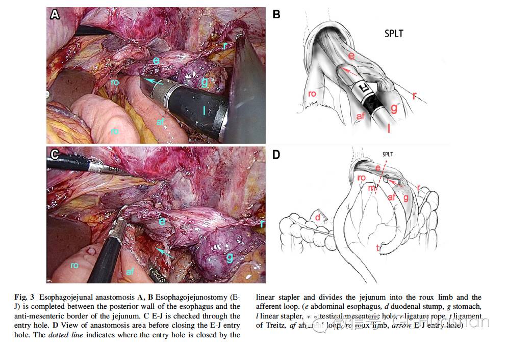 全腹腔镜全胃切除术后吻合新方式- 好大夫在线