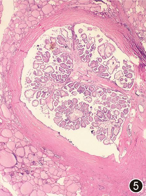 > 2017 版 who 甲状腺肿瘤分类解读 图 5 包裹型甲状腺乳头状癌低倍镜