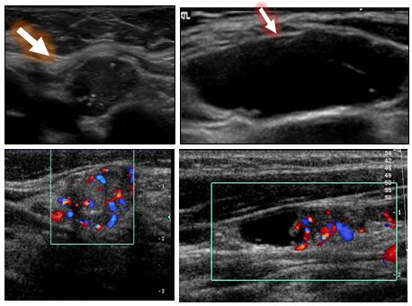 超声在甲状腺癌监测中的应用 (转载)