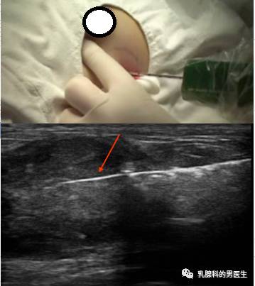 穿刺枪怎么升级乳腺穿刺术（三）_https://www.jmylbn.com_新闻资讯_第36张