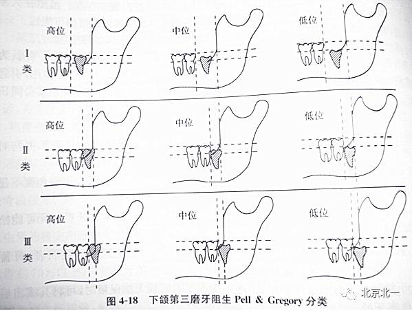 阻生牙(下颌第三磨牙)的分类