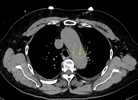 这个要高度警惕主动脉夹层!图4下图的胸部ct平扫,有什么大问题?