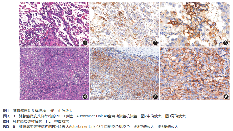 非小细胞肺癌内PD-L1表达及其与肺腺癌新分类的关系