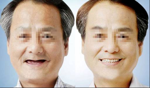 这5类人要做种植牙？别，那是有人忽悠你！