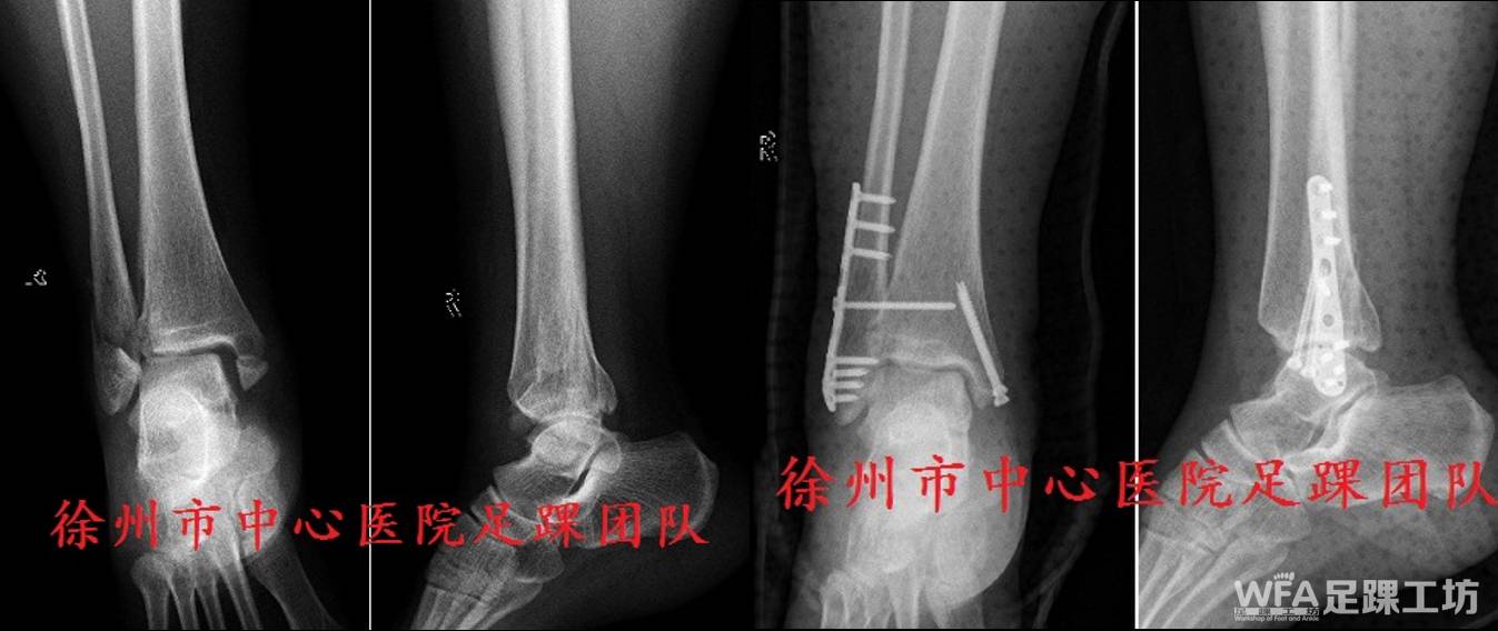 后踝骨块较小,未行内固定