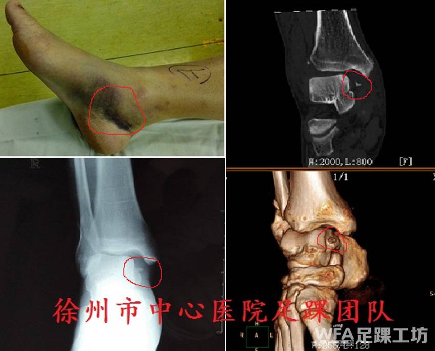 内侧严重出血肿胀,伴有小片撕脱骨折