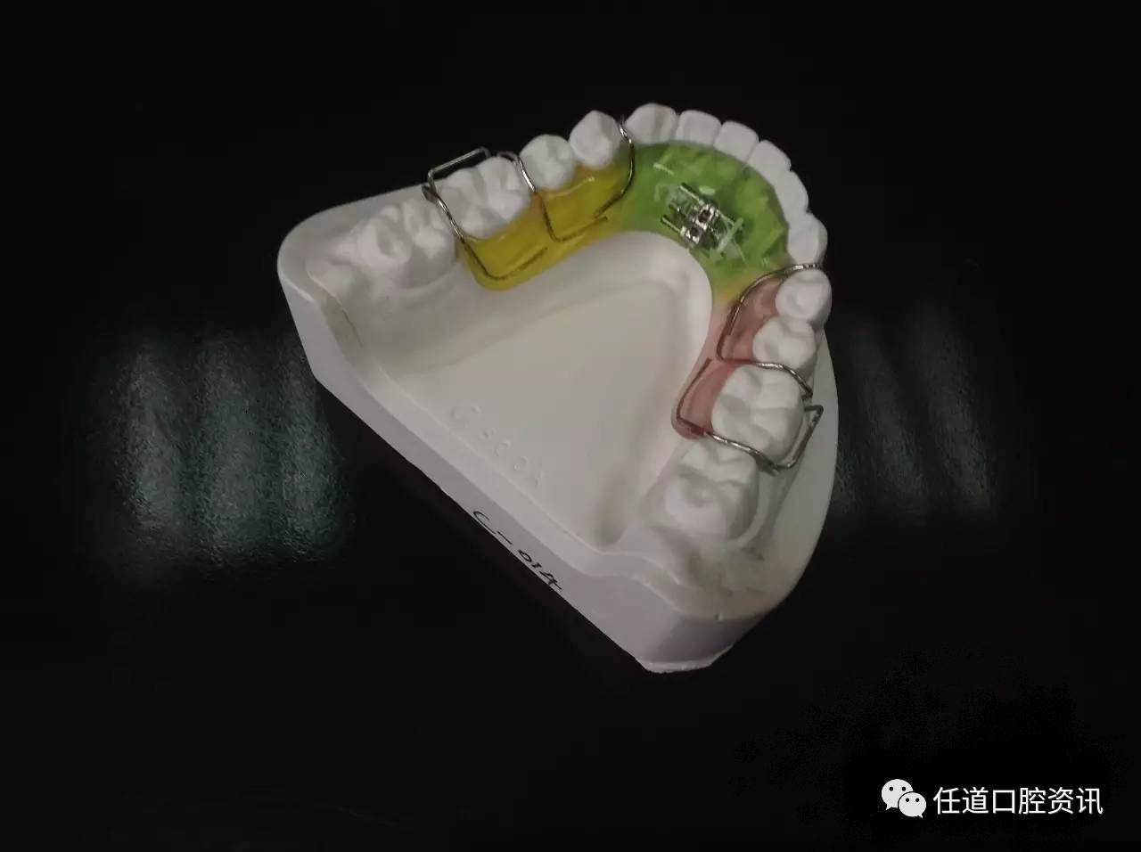 器矫治原理将扩弓螺旋簧与带环焊接在一起或通过基托树脂固定在牙齿上