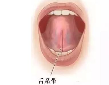 多数家长关心的舌头下面那根筋叫"舌系带",有一些孩子存在舌系带短的