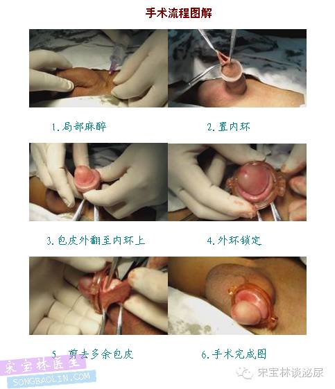 包皮自动切除环怎么用“商环”一次性包皮环切吻合器行包皮环切术后的注意事项_https://www.jmylbn.com_新闻资讯_第4张