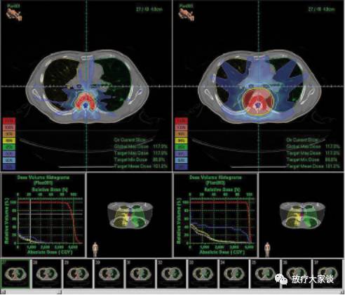 放疗计划系统有哪些放射治疗计划系统（TPS）介绍_https://www.jmylbn.com_新闻资讯_第13张