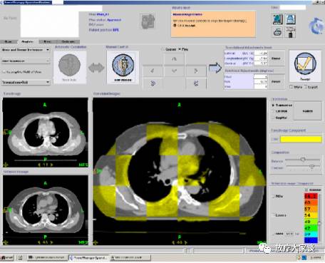 放疗计划系统有哪些放射治疗计划系统（TPS）介绍_https://www.jmylbn.com_新闻资讯_第9张
