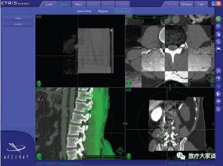 放疗计划系统有哪些放射治疗计划系统（TPS）介绍_https://www.jmylbn.com_新闻资讯_第14张