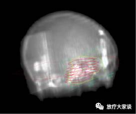 放疗计划系统有哪些放射治疗计划系统（TPS）介绍_https://www.jmylbn.com_新闻资讯_第18张