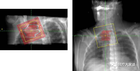 放疗计划系统有哪些放射治疗计划系统（TPS）介绍_https://www.jmylbn.com_新闻资讯_第6张