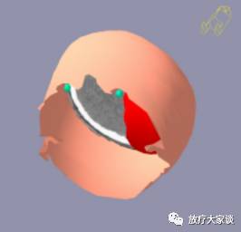 放疗计划系统有哪些放射治疗计划系统（TPS）介绍_https://www.jmylbn.com_新闻资讯_第16张