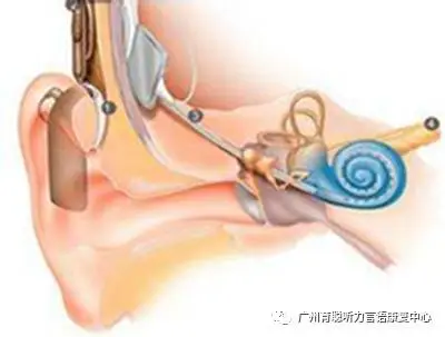 牵手行动·听力重建——人工耳蜗千人救助计划